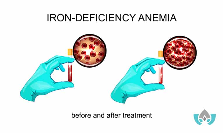 what is anemia and what foods and treatments can help | Mindful Healing | Naturopathic Doctor Mississauga