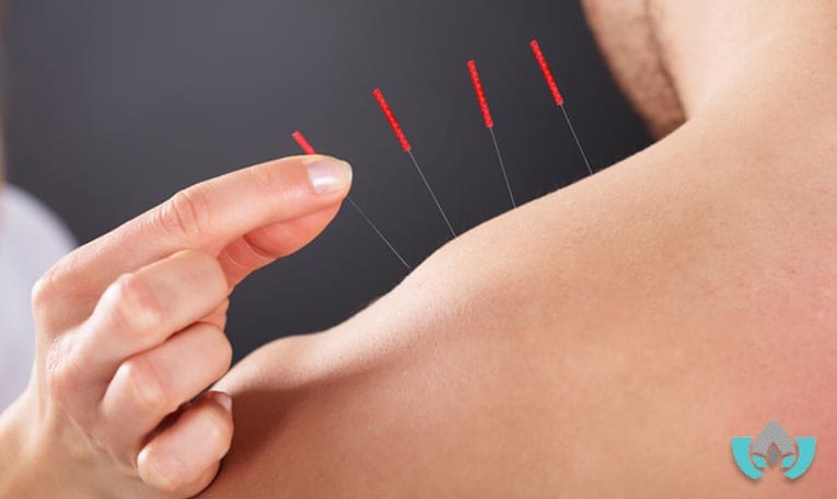How Can Acupuncture Help Strengthen Your Immune System | Mindful Healing | Naturopathic Doctor Mississauga